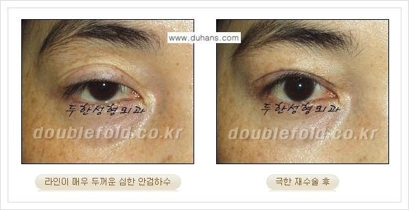 [두한성형외과 경쟁력 쌍꺼풀 재수술] - [극한의 상태에서 쌍꺼풀 재수술 안내 ②] 관련 이미지 4