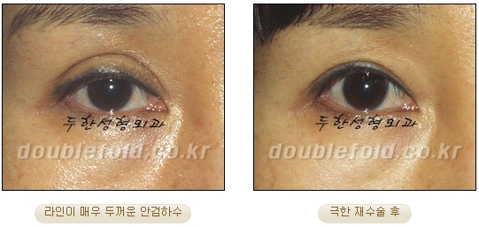 [DoubleFold Plastic Surgery Eye Surgery] - [Revision Surgery for Thick Double Eyelids] image 51