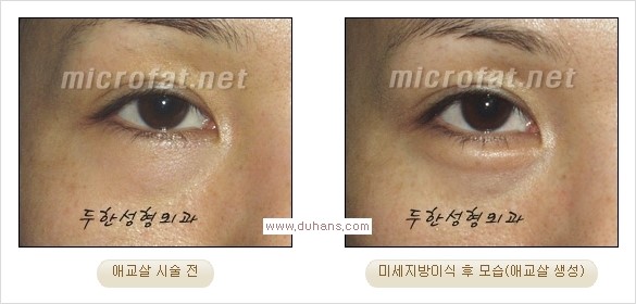 [두한성형외과 경쟁력 눈밑성형] - [타 병원 필러 애교살 시술 부작용을 미세지방이식으로 교정] 관련 이미지 25