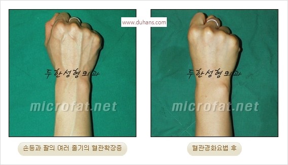 [두한성형외과 경쟁력 정맥류] - [손, 팔의 정맥확장증(혈관확장증) 치료 방법 안내] 관련 이미지 9