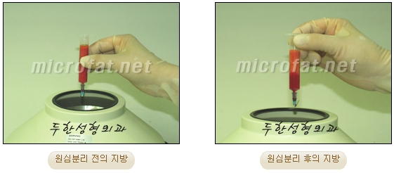 [두한성형외과 미세지방이식] - [무턱교정 안내] 관련 이미지 10