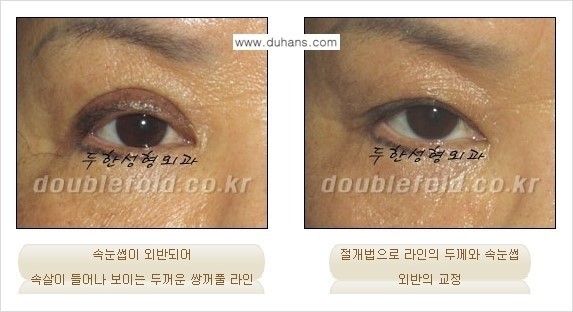 [두한성형외과 경쟁력 눈성형] - [속눈썹이 외반되어 점막이 들어나 보이는 두꺼운 쌍꺼풀 라인 교정] 관련 이미지 8