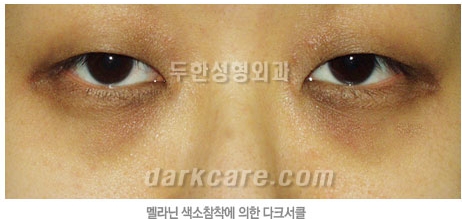 Duhan Plastic Surgery Dark Circle Improvement - What Causes Dark Circles? What Types of Dark Circles Are There? image 17