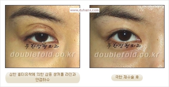 [두한성형외과 경쟁력 쌍꺼풀 재수술] - [피부 여유분이 부족해서 토안증이 발생한 경우 극한 재수술] 관련 이미지 11