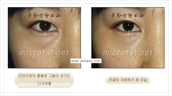 [두한성형외과 경쟁력 눈밑성형] - [눈밑지방제거, 눈위지방제거 안내 1.] 관련 이미지 21