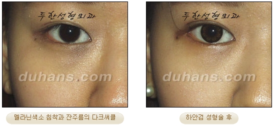 [Duhan Plastic Surgery Ophthalmic Plastic Surgery] - [Lower Blepharoplasty] image 27