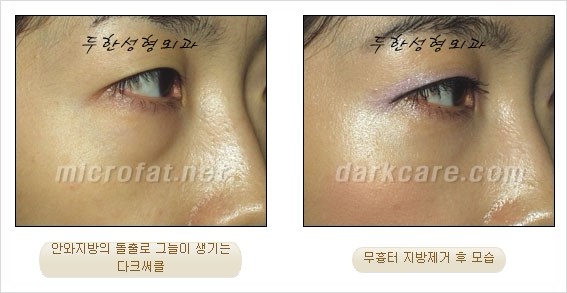 [두한성형외과 쌍커풀수술] - [눈성형 방법에 대한 자주하는 질문과 답변] 관련 이미지 171