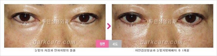 ​[두한성형외과 경쟁력 눈밑성형 리더] - [눈밑 다크써클의 증상, 원인, 종류, 치료방법 안내] 관련 이미지 74
