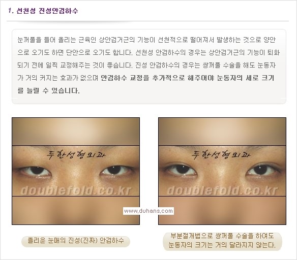 [두한성형외과 경쟁력 쌍꺼풀 재수술, 극한 눈재수술] - [안검하수 종류 안내] 관련 이미지 3