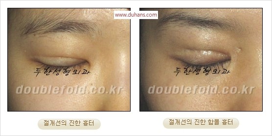 [두한성형외과 경쟁력 쌍꺼풀 재수술] - [쌍꺼풀 재수술 과정] 관련 이미지 54