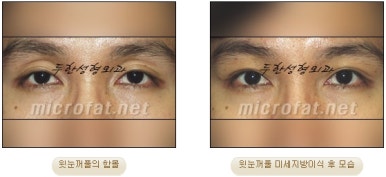 [Doohan Plastic Surgery Autologous Fat Grafting] - [Sunken Eye Fat Grafting] image 22