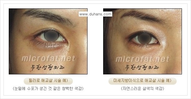 [두한성형외과 경쟁력 눈밑성형] - [눈밑 애교살 시술을 위한 미세지방이식] 관련 이미지 13