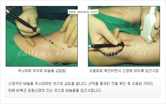 [두한성형외과 경쟁력 종아리성형] - [초음파 유도 선택적 신경차단술 안내 ②] 관련 이미지 8