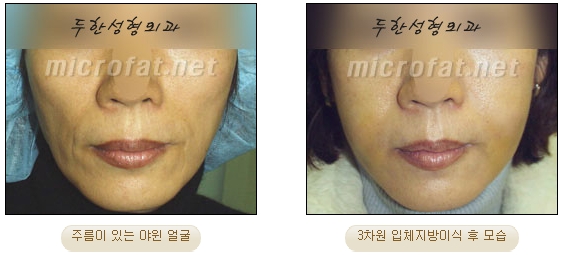 얼굴지방이식 두한성형외과 - 볼지방이식 관련 이미지 11
