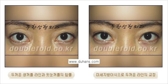 [두한성형외과 NO.1 눈성형] - [함몰된(꺼진) 눈꺼풀에서 쌍꺼풀 라인 교정 2.] 관련 이미지 14