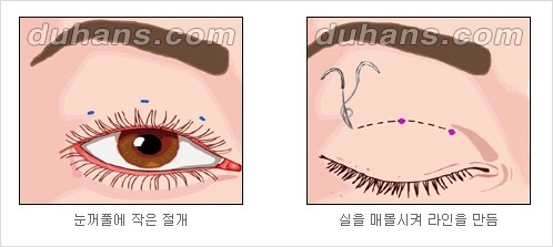 [두한성형외과 경쟁력 눈성형] - [눈성형 방법에 대한 흔한 질문과 답변 안내] 관련 이미지 8