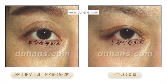 [두한성형외과 경쟁력 눈성형] - [두꺼운 라인을 교정하는 극한 눈 재수술 2.] 관련 이미지 12