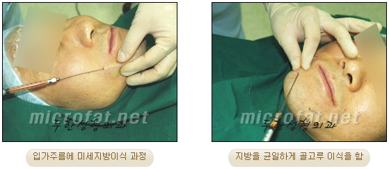 Fat Grafting Leader Duhan Plastic Surgery - Everything About Fat Grafting image 62