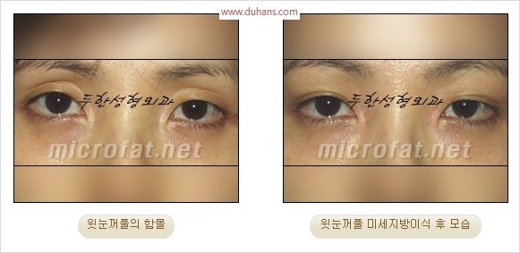 [두한성형외과 경쟁력 눈성형 리더] - [윗눈꺼풀 함몰( #꺼진눈꺼풀) 미세지방이식과 상안검성형]#꺼진눈성형 , #눈위함몰 관련 이미지 26