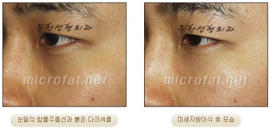 Fat Grafting Leader Duhan Plastic Surgery - Everything About Fat Grafting image 45