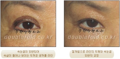 [Duhan Plastic Surgery Eye Surgery] - [Asymmetric Line, Eyelash Eversion, Deep Fixation] image 30