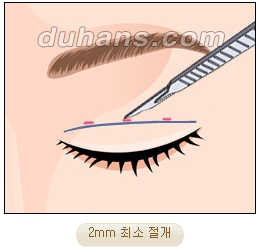 눈성형잘하는곳 두한성형외과 - 겹쌍꺼풀 관련 이미지 8