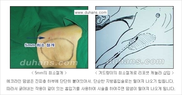 [두한성형외과 성형 FOCUS 지방흡입] - [액취증 - 다한증 초음파 컷터 지방흡입 ⑤] 관련 이미지 6