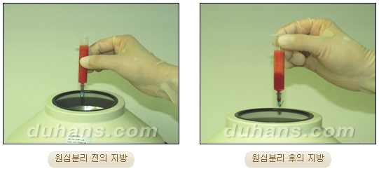 [Duhan Plastic Surgery Micro Fat Grafting] - [Receded Chin, Small Chin, Cleft Chin, Chin Line Asymmetry Correction] image 7