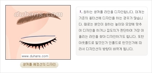 [두한성형외과 경쟁력 눈성형] - [쌍꺼풀 재수술 방법 - 부분절개법(Partial incision method) 과정 안내] 관련 이미지 2
