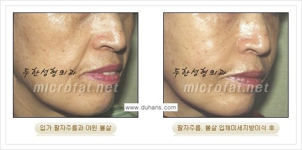 ⁠[두한성형외과 경쟁력 미세지방이식] - [상표등록 "Col-fat(콜펫) 지방이식"으로 교정이 가능한 부위] 관련 이미지 10
