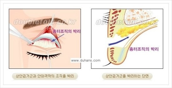 [두한성형외과 경쟁력 눈성형] - [극한 재수술, 함몰된 눈꺼풀 라인교정, 안검하수(졸리운 눈매)] 관련 이미지 91