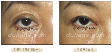 [Special Double Eyelid Revision Surgery at Duhan Plastic Surgery] - [Restorative Surgery for Damaged Double Eyelid Eye Shape] image 9