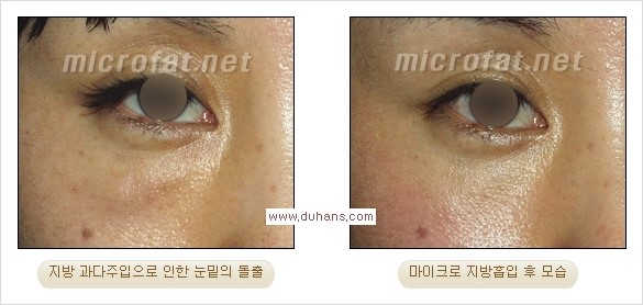 ​[두한성형외과 경쟁력 지방이식] - [지방이식 부작용 이후 마이크로 지방흡입, 마이크로 지방흡입 이후 부작용 없는 지방이식 방법] 관련 이미지 9