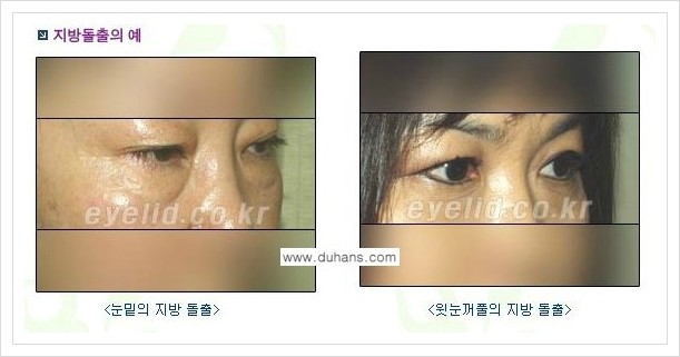 [두한성형외과 경쟁력 지방제거] - [눈꺼풀 지방제거 흔한 질문과 답변 모음] 관련 이미지 1