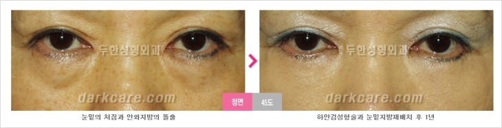 ​[두한성형외과 경쟁력 눈밑성형 리더] - [눈밑 다크써클의 증상, 원인, 종류, 치료방법 안내] 관련 이미지 56