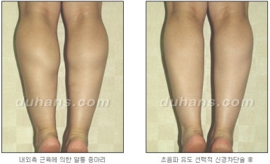 [두한성형외과 종아리 퇴축] - [종아리 퇴축술 재발 재수술] 관련 이미지 25