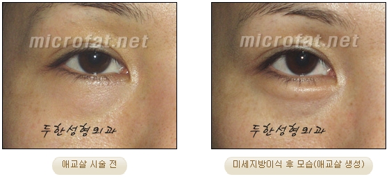 Duhan Plastic Surgery Under-Eye Surgery - Correction with Fat Grafting After Aegyo-Sal Filler image 14