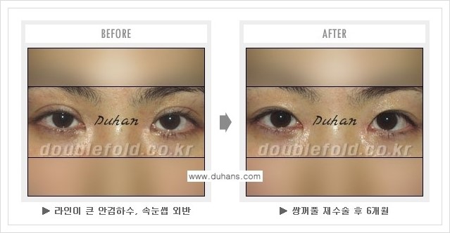 [두한성형외과 경쟁력 쌍꺼풀 재수술, 극한 눈재수술] - [쌍꺼풀 재수술, 극한 눈재수술 관련 자주하는 질문과 답변] 관련 이미지 10