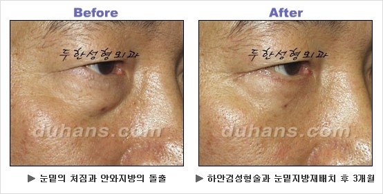 [두한성형외과 경쟁력 동안성형 리더] - ​[미간주름, 이마주름, 안검성형, 이마거상술, 눈썹거상술] 관련 이미지 114