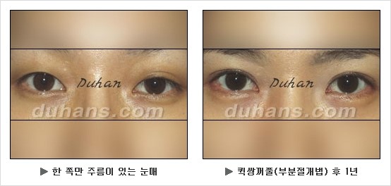 [두한성형외과 쌍커풀수술] - [눈성형 방법에 대한 자주하는 질문과 답변] 관련 이미지 111
