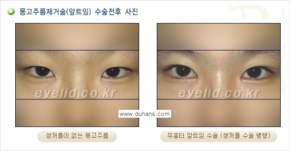 [두한성형외과 경쟁력 눈성형] - [몽고주름 제거수술, 앞트임 수술 안내] 관련 이미지 14