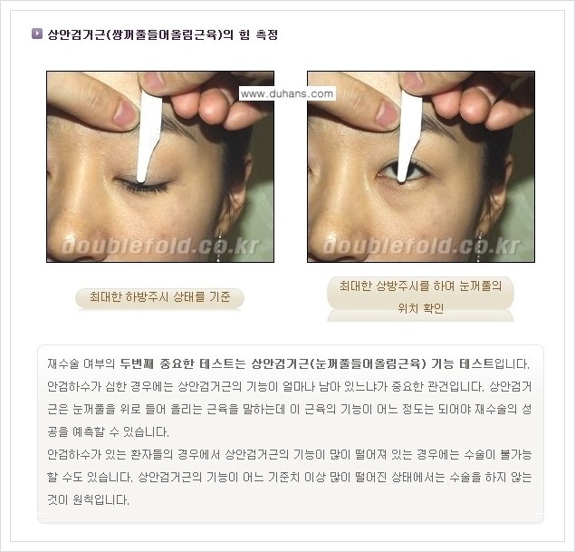 [두한성형외과 경쟁력 쌍꺼풀 재수술, 극한 눈재수술] - [쌍꺼풀 재수술을 위한 검사와 테스트] 관련 이미지 2