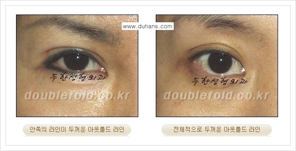 [두한성형외과 경쟁력 쌍꺼풀(눈) 재수술] - [심한 아웃폴드 라인을 인폴드 라인으로의 교정 안내] 관련 이미지 2