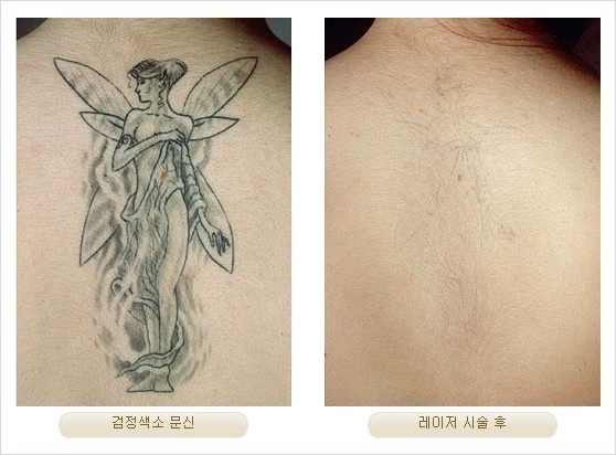 [두한성형외과 경쟁력 안전성형] - [최첨단 장비를 이용한 흉터, 점, 주근깨, 잡티, 문신제거 레이저 시술] 관련 이미지 30