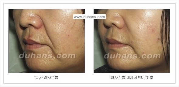 ​[두한성형외과 경쟁력 주름성형] - [주름교정을 위한 미세지방이식 안내 2.] 관련 이미지 3