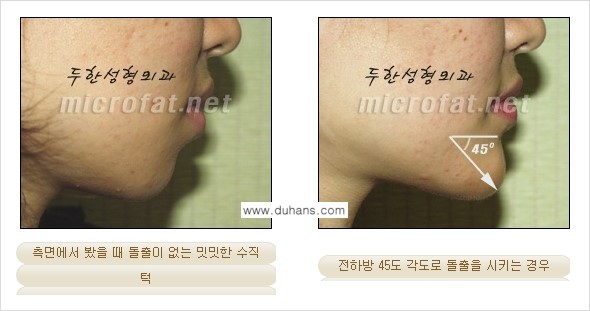 [두한성형외과의 경쟁력 미세지방이식] - [무턱교정 - 턱 미세지방이식 안내 1.] 관련 이미지 7