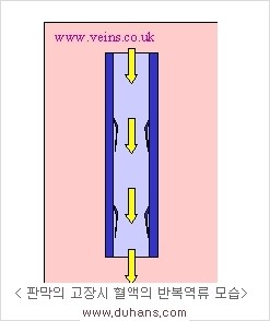 [두한성형외과 경쟁력 정맥류 치료] - [정맥류의 원인과 문제점, 정맥류 진단 방법] 관련 이미지 7