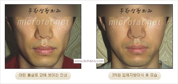 [두한성형외과 경쟁력 미세지방이식] - [볼살, 이마, 측두부 - 안면윤곽 미세지방이식] 관련 이미지 12
