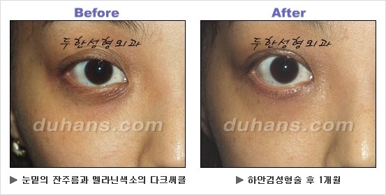[두한성형외과 경쟁력 동안성형 리더] - ​[미간주름, 이마주름, 안검성형, 이마거상술, 눈썹거상술] 관련 이미지 105
