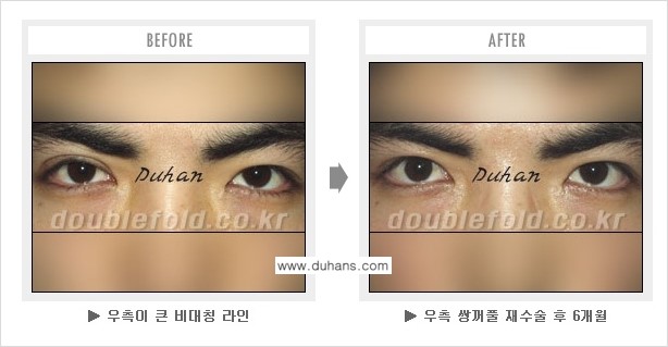 [두한성형외과 쌍꺼풀 재수술] - [피부 여유분이 부족해서 토안증이 발생한 경우] 관련 이미지 5
